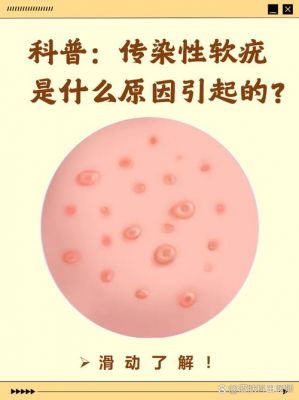 水猴子图片皮肤病症状?水猴子图片皮肤病症状可以吃虾吗?